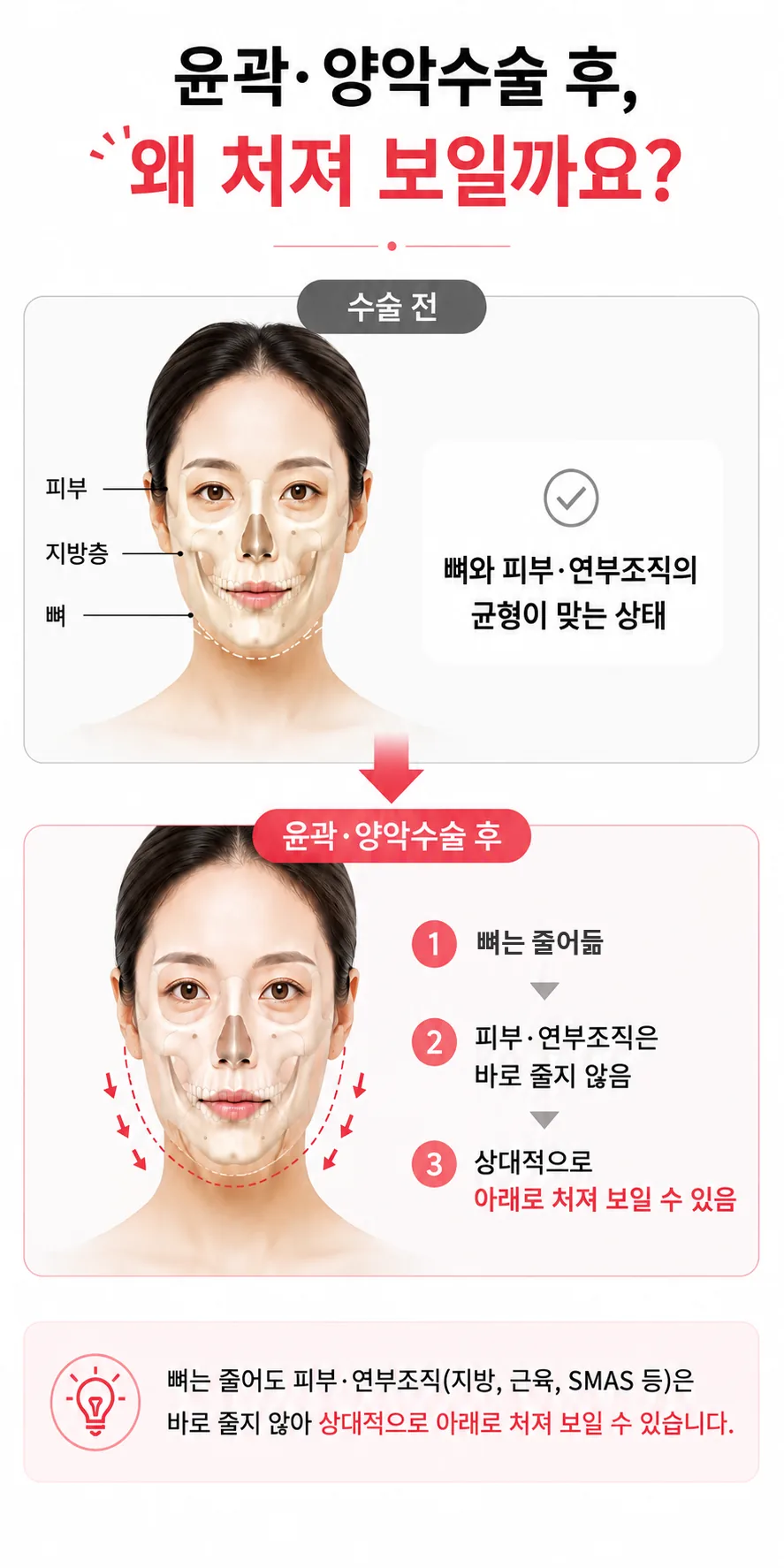 윤곽·양악수술 후 뼈는 줄어도 피부·연부조직은 바로 줄지 않아 상대적으로 아래로 처져 보일 수 있음을 수술 전후 구조로 비교한 그림